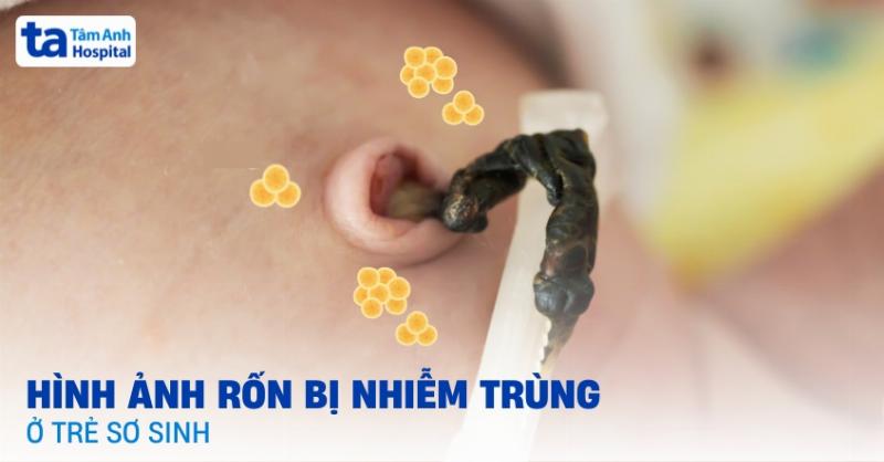 Trẻ Sơ Sinh Khò Khè Phải Làm Sao? Giải Mã Nỗi Lo Của Cha Mẹ