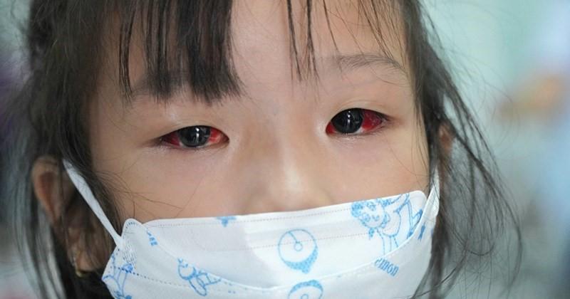Đau Mắt Đỏ Bao Lâu Hết? Giải Mã Thời Gian Và Cách Vượt Qua Căn Bệnh Phiền Toái Này