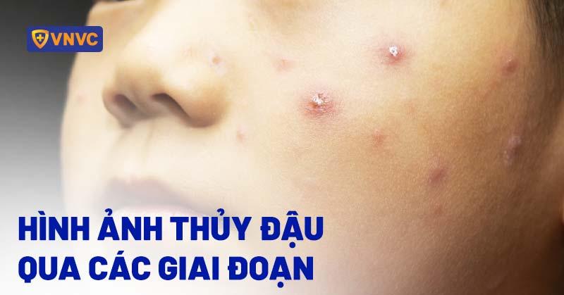 Hình ảnh các giai đoạn phát ban điển hình của bệnh đậu mùa khỉ trên da người