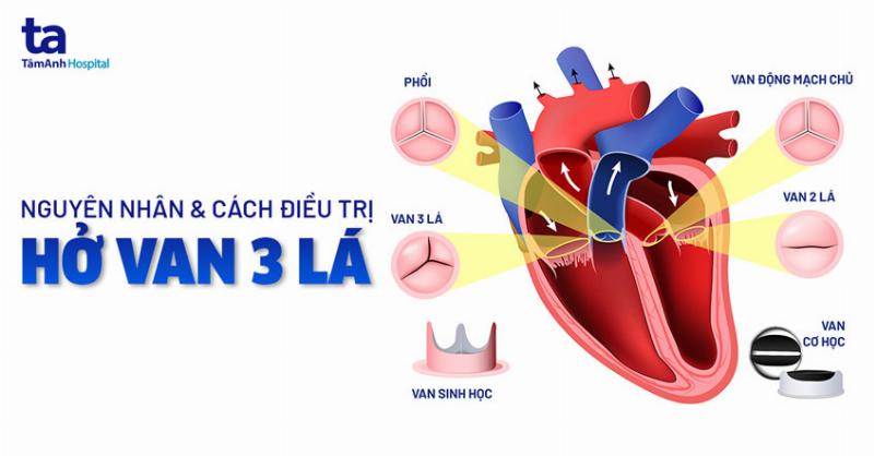 Hở Van 3 Lá 3/4: Hiểu Rõ Để Chủ Động Chăm Sóc Sức Khỏe Tim Mạch