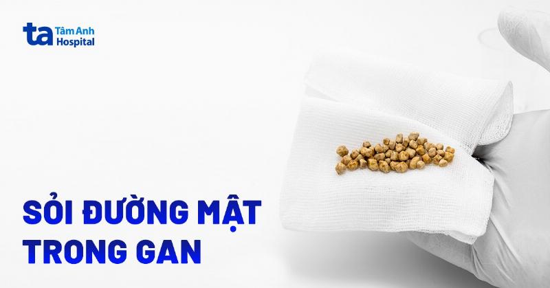 Sỏi đường mật trong gan: Hiểu Rõ Căn Nguyên và Giải Pháp Toàn Diện