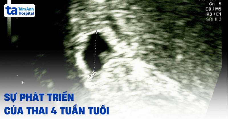 Minh họa sự phát triển thai sớm theo tuần và thời điểm siêu âm chưa thấy phôi thai