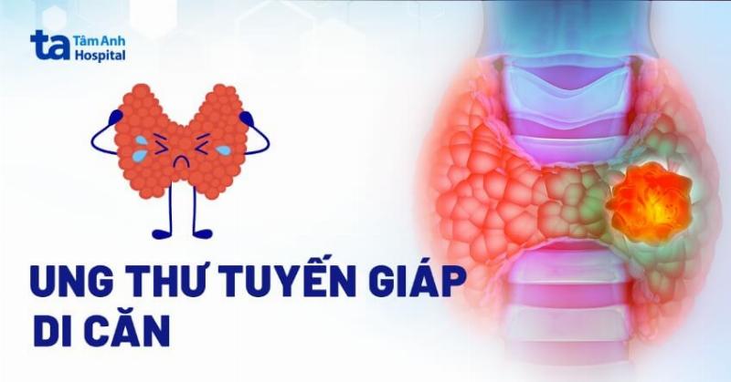 Ung thư tuyến giáp di căn: Những điều quan trọng bạn cần thấu hiểu