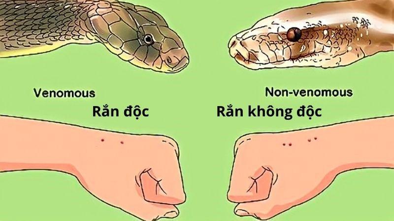 Hình ảnh vết cắn do rắn màu vàng độc gây ra trên da người với dấu hiệu sưng tấy, bầm tím