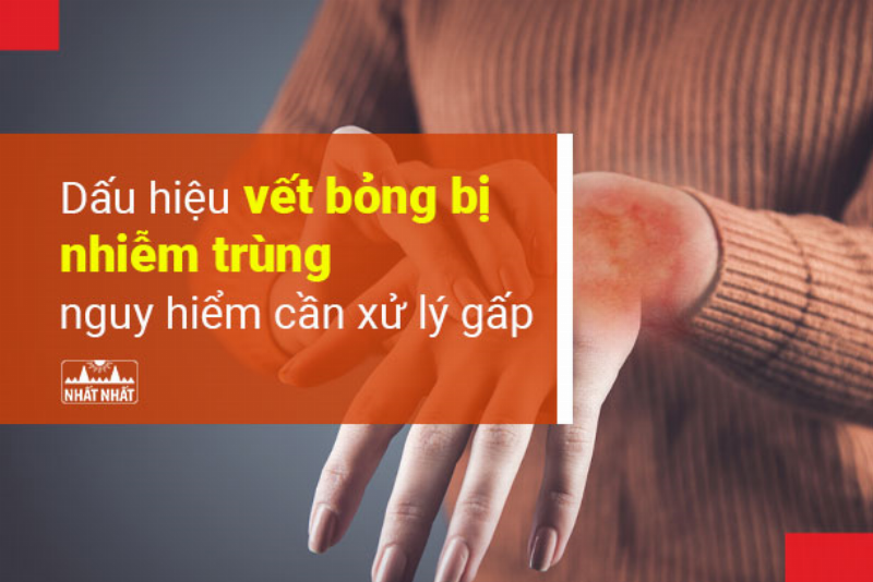 Dấu hiệu nhận biết vết phỏng bị nhiễm trùng