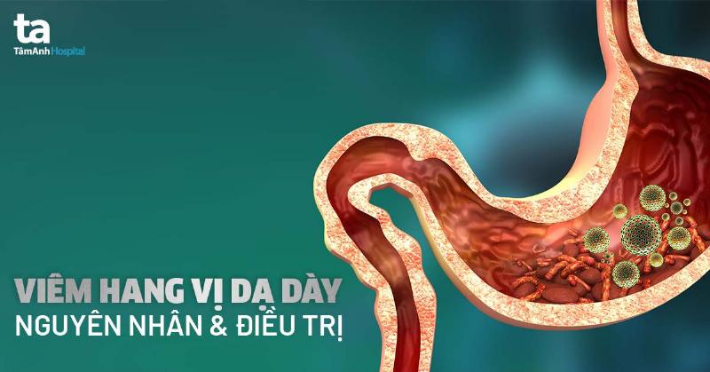 Hang Vị Dạ Dày Ở Đâu? Tìm Hiểu Tận Gốc Về Khu Vực Quan Trọng Này
