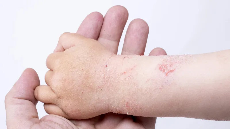 Hình ảnh minh họa: Triệu chứng của viêm da cơ địa