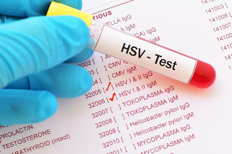 Virus Herpes Simplex gây lở miệng ở môi dưới kính hiển vi