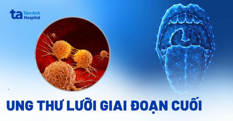 Ung Thư Lưỡi Di Căn Hạch Cổ: Nhận Biết Sớm Cứu Sống Bạn