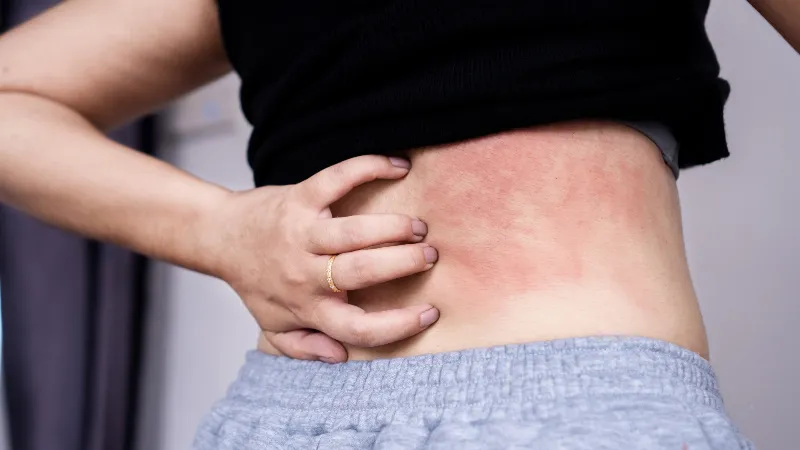 Dấu hiệu nhiễm sán chó: Nhận biết sớm bảo vệ sức khỏe của bạn và gia đình
