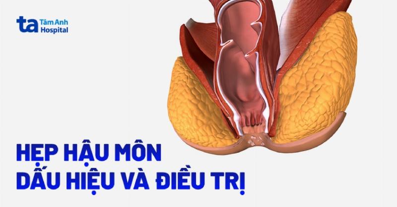 Hẹp Hậu Môn Sau Mổ Trĩ: Nguyên Nhân, Triệu Chứng và Cách Khắc Phục