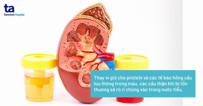 Nguyên Nhân Viêm Cầu Thận: Thủ Phạm Thầm Lặng Gây Hại Thận Của Bạn