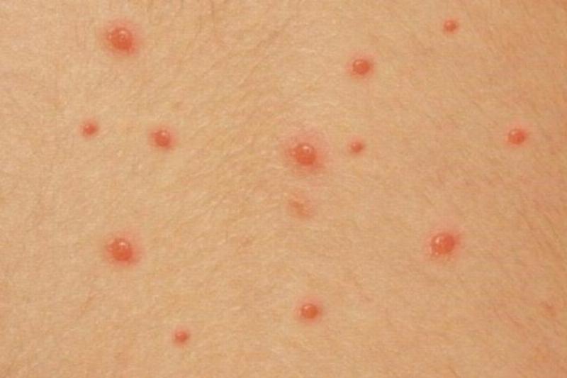 Minh họa các biến chứng nguy hiểm của thủy đậu ở người lớn cần cấp cứu
