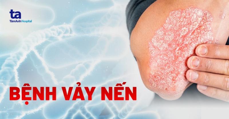 Triệu Chứng Bệnh Vảy Nến: Dấu Hiệu Nào Bạn Cần Lưu Ý?