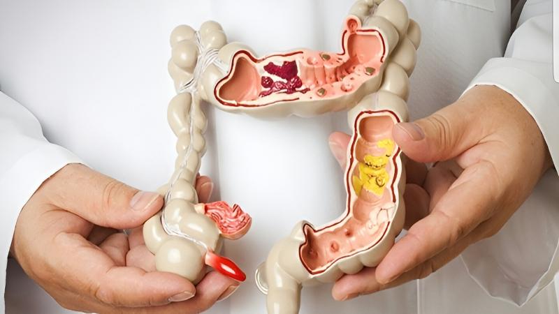 Trước khi nội soi đại tràng cần làm gì: Hướng dẫn chi tiết A-Z