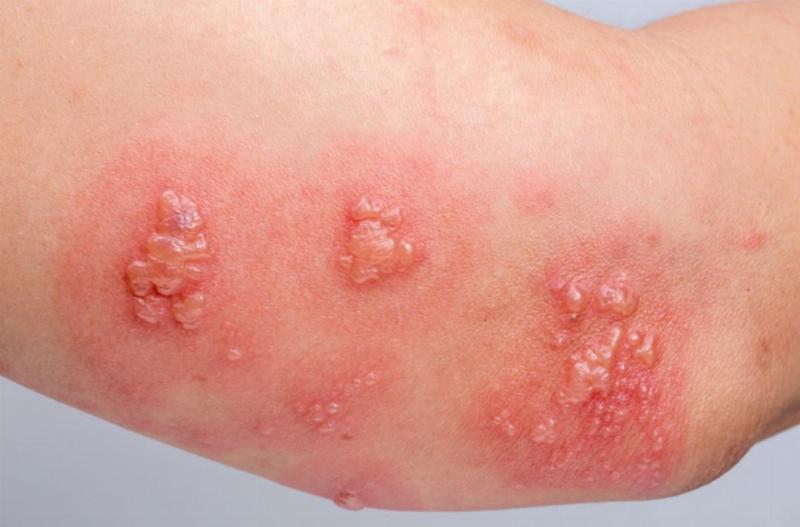 Bệnh Zona Thần Kinh: Triệu Chứng, Cách Chữa Trị Và Phòng Ngừa Hiệu Quả
