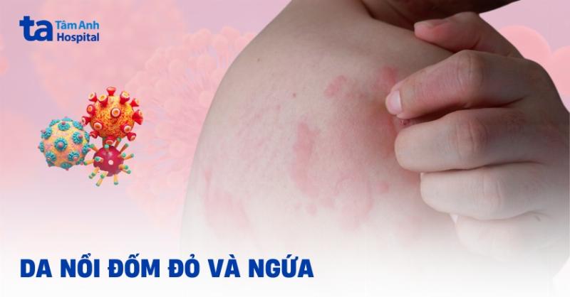 Bị Chấm Đỏ Trên Da: Nguyên Nhân, Dấu Hiệu Và Cách Xử Lý Hiệu Quả