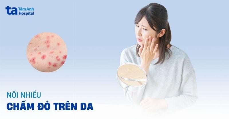 Hình ảnh minh họa các hành động phòng ngừa chấm đỏ trên da, như bôi kem chống nắng, ăn uống lành mạnh, uống nước đủ