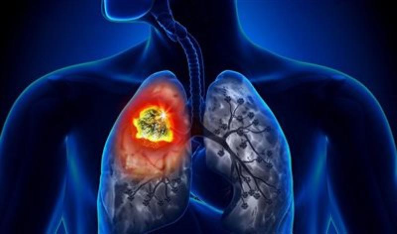 U Não Giai Đoạn Cuối: Hiểu Đúng Để Chăm Sóc Tốt Nhất