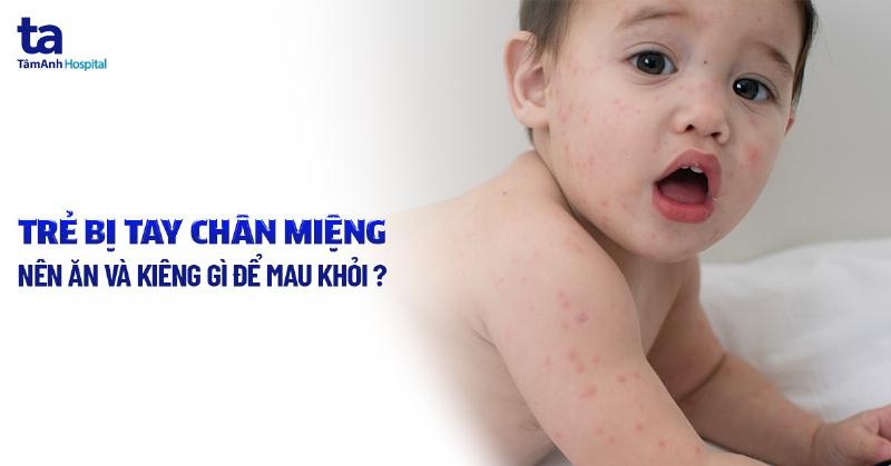 Tổng Hợp Cách Điều Trị Bệnh Tay Chân Miệng Tại Nhà: Hướng Dẫn Chi Tiết