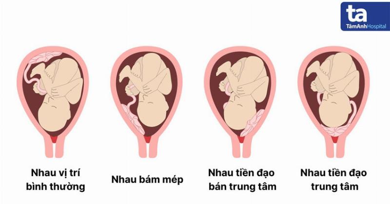 Hình ảnh bác sĩ sản khoa đang tư vấn cho mẹ bầu về cách quản lý thai kỳ khi bị nhau tiền đạo, thể hiện sự hỗ trợ y tế chuyên nghiệp.