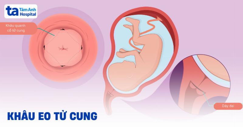 Tâm Sự Của Những Bà Mẹ Khâu Eo Tử Cung: Chặng Đường Mong Con Yêu