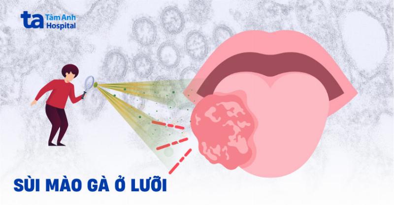 Cuống Lưỡi Sùi Mào Gà Ở Lưỡi: Nhận Biết, Chẩn Đoán và Cách Xử Trí