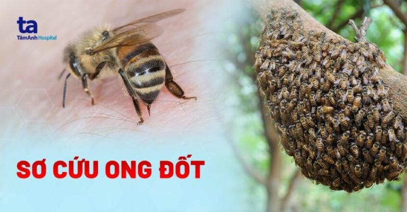Dấu hiệu dị ứng ong đốt nặng cần cấp cứu y tế ngay lập tức
