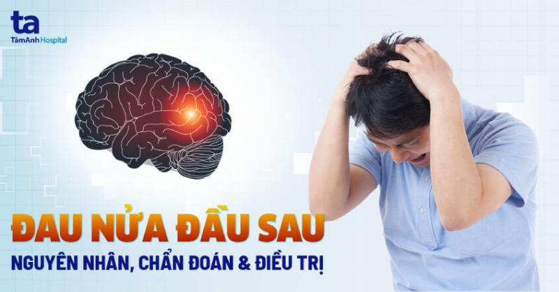 Hình ảnh minh họa vị trí đau nhức ở đỉnh đầu, giúp người đọc dễ dàng xác định khu vực cảm giác đau