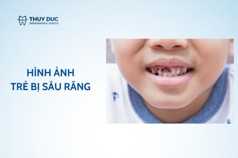 Đau Răng Thì Làm Gì? Cách Giảm Đau Tức Thì Và Biết Lúc Nào Cần Gặp Nha Sĩ Ngay
