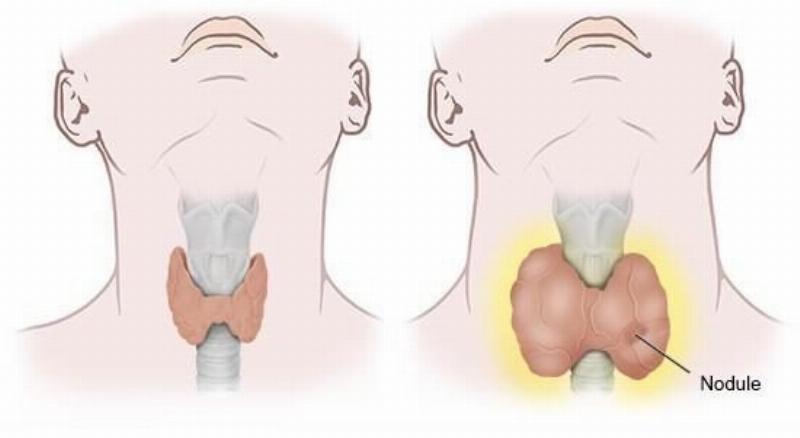 Mối liên hệ giữa di truyền và nguy cơ mắc bệnh cường giáp