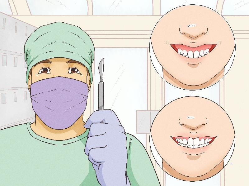 Hình ảnh một khách hàng nở nụ cười rạng rỡ, thể hiện sự hài lòng sau khi tiêm HA cải thiện nếp nhăn hoặc định hình khuôn mặt.