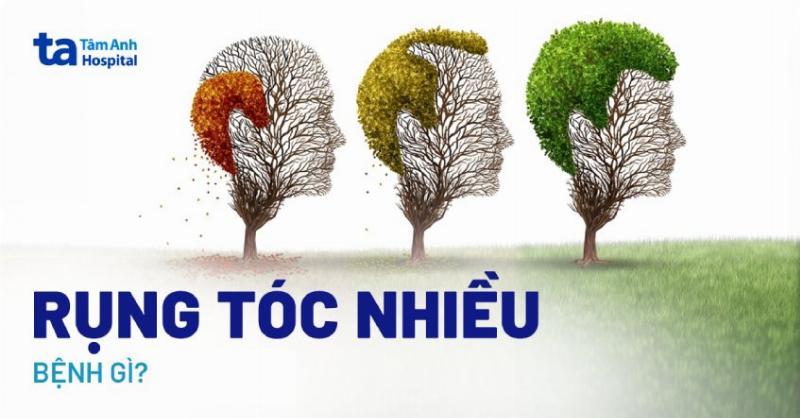 Những dấu hiệu rụng tóc bất thường cần đi khám chuyên gia, minh họa rụng nhiều tóc là bệnh gì và thời điểm cần hỗ trợ y tế