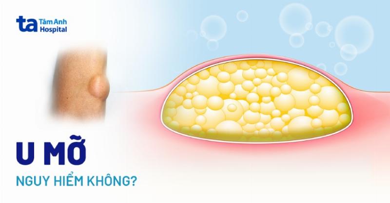 Khối U Lành Tính Có Đau Không? Giải Mã Điều Ít Ai Ngờ Tới