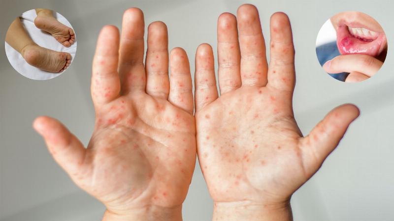 Mẹo Dân Gian Chữa Bệnh Chân Tay Miệng: Thực Hư & Lời Khuyên Chuyên Gia
