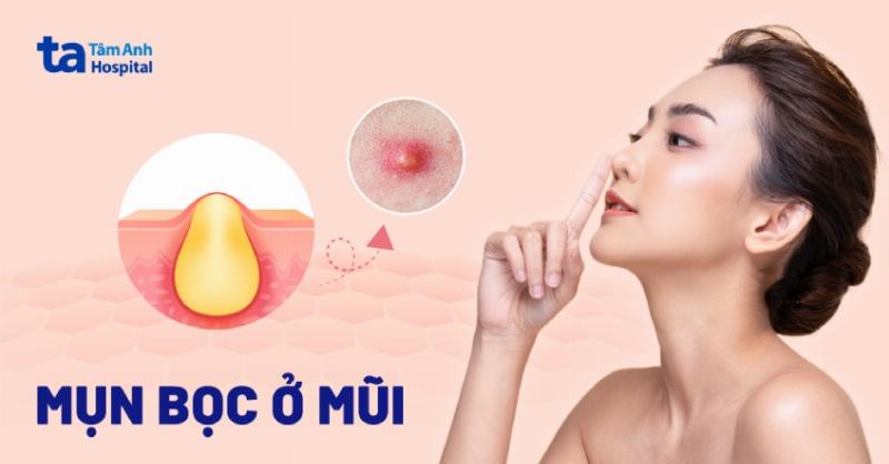 Hình ảnh minh họa các mẹo trị mụn bọc tại nhà phổ biến, cần được đánh giá khoa học khi áp dụng để trị mụn bọc ở mũi sau 1 đêm