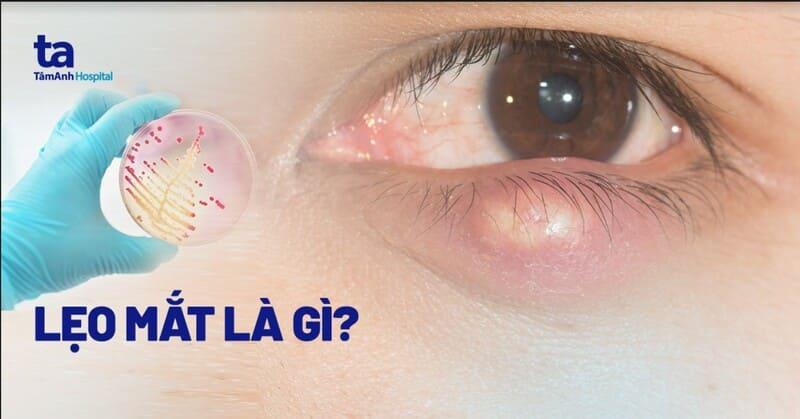 Mụt Lẹo Mí Mắt: Làm Sao Để Hết Nhanh Chóng Và An Toàn Tại Nhà?