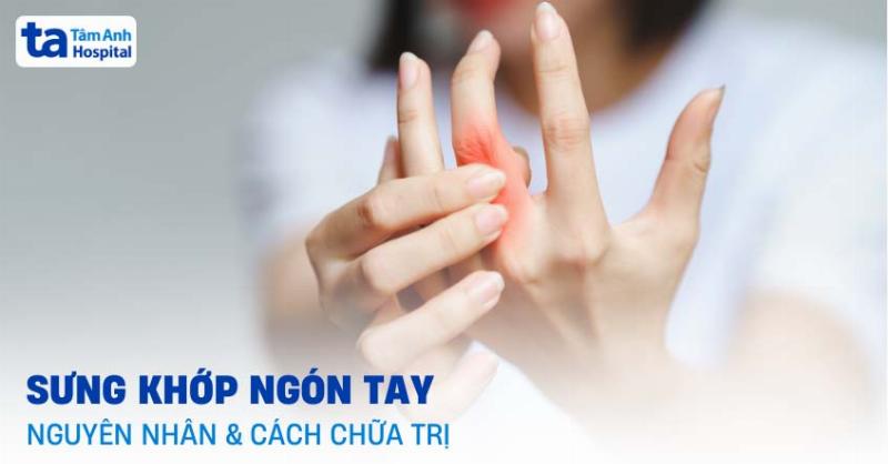 Cách Chữa Ngón Tay Bị Sưng: Hiểu Rõ Nguyên Nhân Và Giải Pháp Hiệu Quả