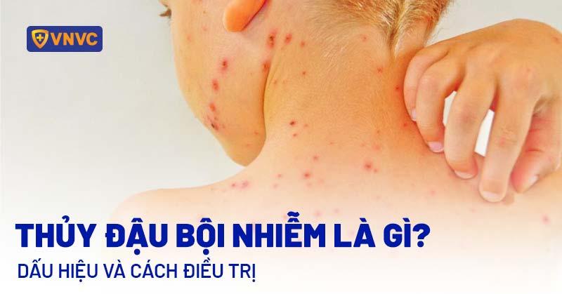 Hình ảnh minh họa bàn tay gãi vào vùng da nổi mụn nước thủy đậu, thể hiện nguy cơ nhiễm trùng
