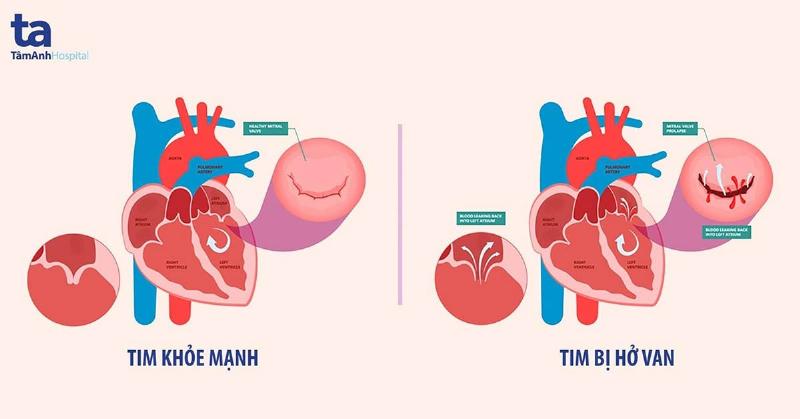 Hở Nhẹ Van 2 Lá: Hiểu Rõ Để An Tâm Sống Khỏe