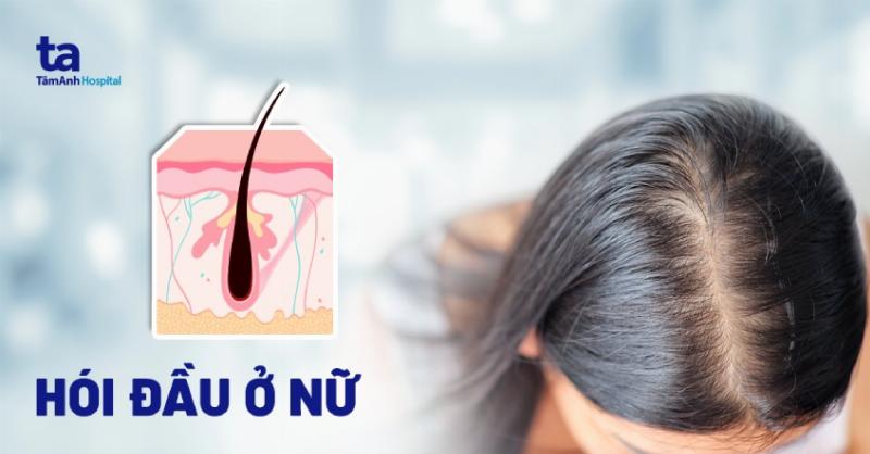 Bí quyết trị hói đầu ở nữ giới: Lấy lại mái tóc dày mượt không còn là mơ ước