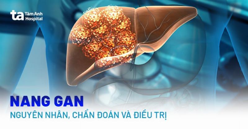 Nguyên nhân dẫn đến nang gan: Chuyên gia giải đáp cặn kẽ