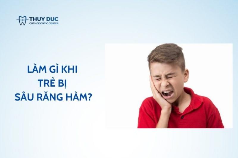 Em bé bị sâu răng: Dấu hiệu, nguyên nhân và cách chăm sóc hiệu quả