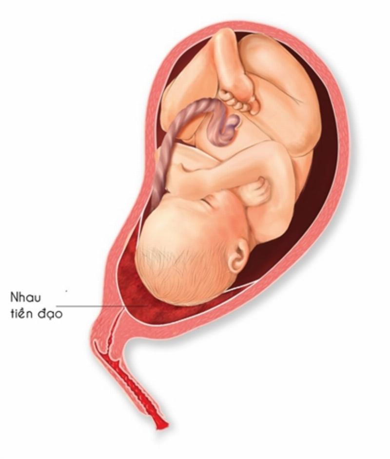 Minh họa nguy cơ chảy máu khi nhau tiền đạo gây cản trở đường sinh của em bé và ảnh hưởng đến mẹ bầu