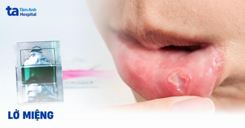 Cách Trị Nhiệt Miệng Nhanh Nhất Tại Nhà: Bí Quyết Từ Chuyên Gia Nha Khoa Bảo Anh