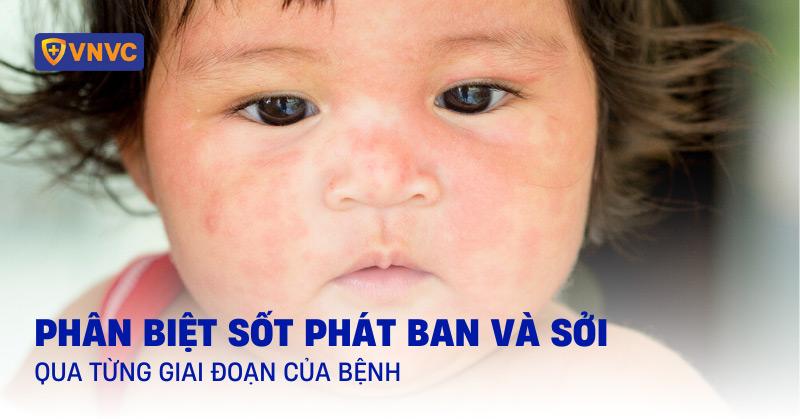 Bị Nổi Đốm Đỏ Trên Da: Hiểu Rõ Nguyên Nhân Và Cách Xử Lý An Toàn