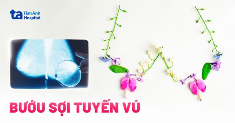 Bướu Sợi Tuyến Ác Tính: Hiểu Rõ Để Bảo Vệ Sức Khỏe Của Bạn