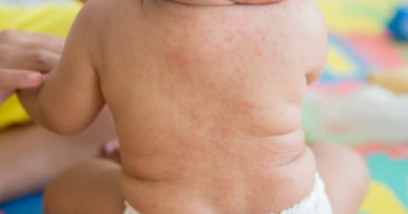 Biện pháp phòng ngừa sốt siêu vi hiệu quả