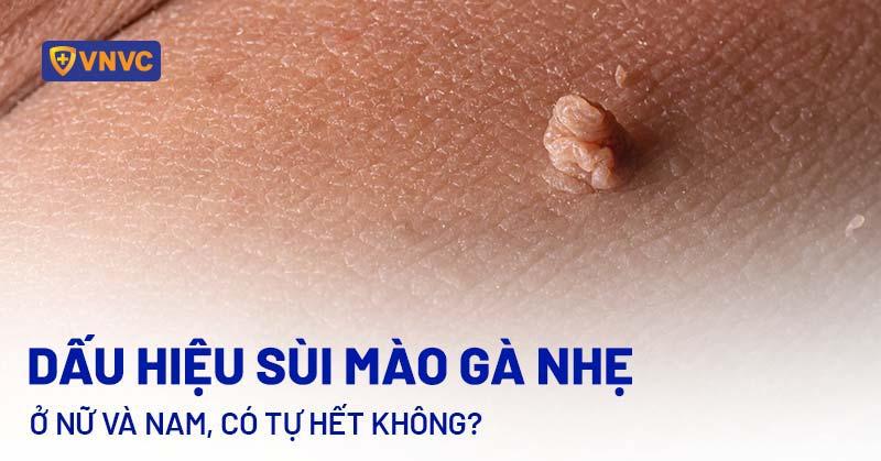 Sùi Mào Gà Có Chữa Được Không? Sự Thật Từ Chuyên Gia