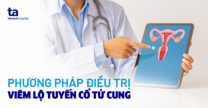 [Điều trị viêm lộ tuyến cổ tử cung]: Cẩm nang chi tiết từ A đến Z
